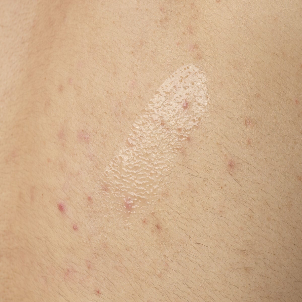salicylic-acid-0-5-body-serum-z2 ORD-salicylic-acid-05-body-240ml-application.jpg
