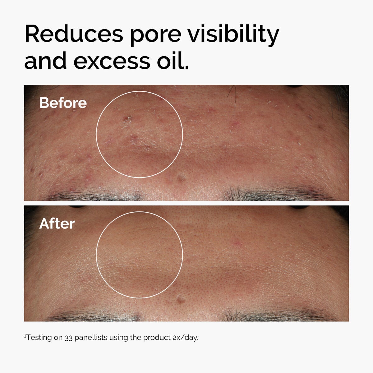 niacinamide-10-zinc-1-p5 ord-niacinamide-zinc-blemish-serum-before-after-pores.jpg