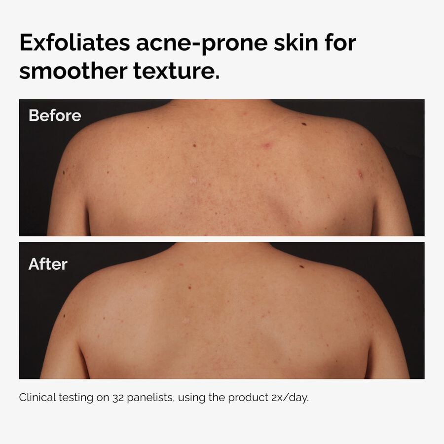 the-body-care-collection-k6 ord-salicylic-acid-body-serum-before-after-graphic-NA.jpg