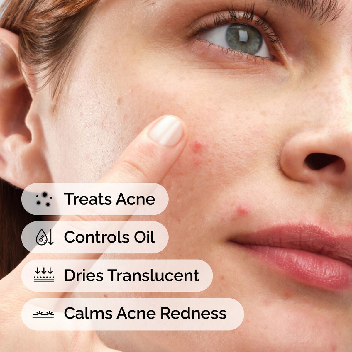 sulfur-10-powder-to-cream-concentrate-o5 ord-sulfur-10pct-powder-to-cream-concentrate-model-application-with-benefits-acne.jpg
