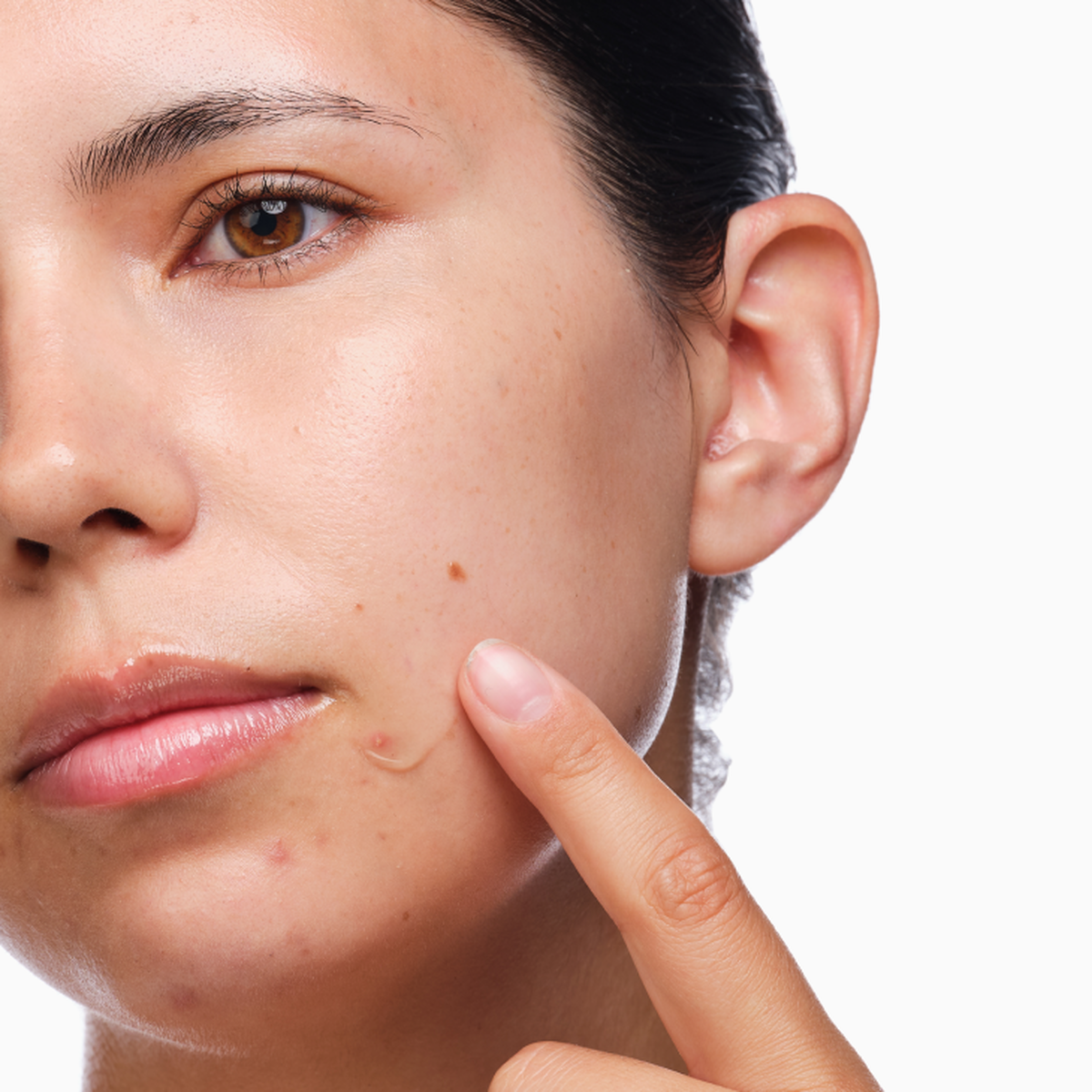 the-acne-set-o8 rdn-the-acne-set-application.png